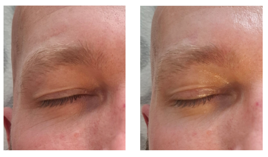 Voor-en-na-opname van de huid rond het oog na een OXYeMOTION-behandeling
